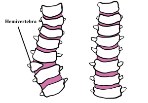 Hemivértebra